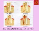 Giai đoạn phát triển của bệnh sâu răng